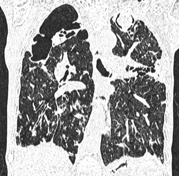 Aspergilloma- with Monod sign (Radiopaedia 44737-48532 Coronal lung window 269).jpg
