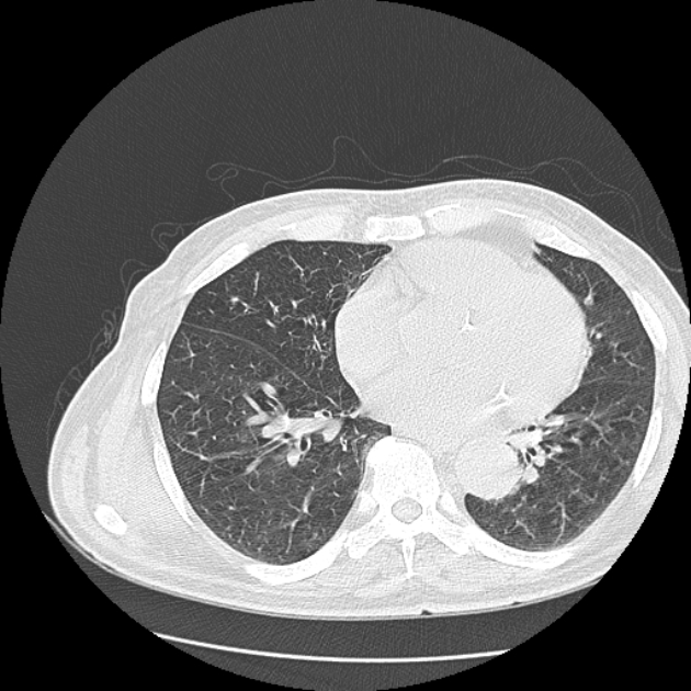 Aspergilloma (Radiopaedia 44592-48327 Axial lung window 58).jpg