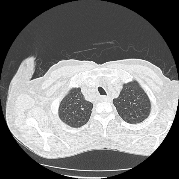 Aspergilloma (Radiopaedia 44592-48327 Axial lung window 6).jpg