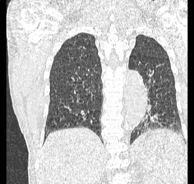 Aspergilloma (Radiopaedia 44592-48327 Coronal lung window 96).jpg