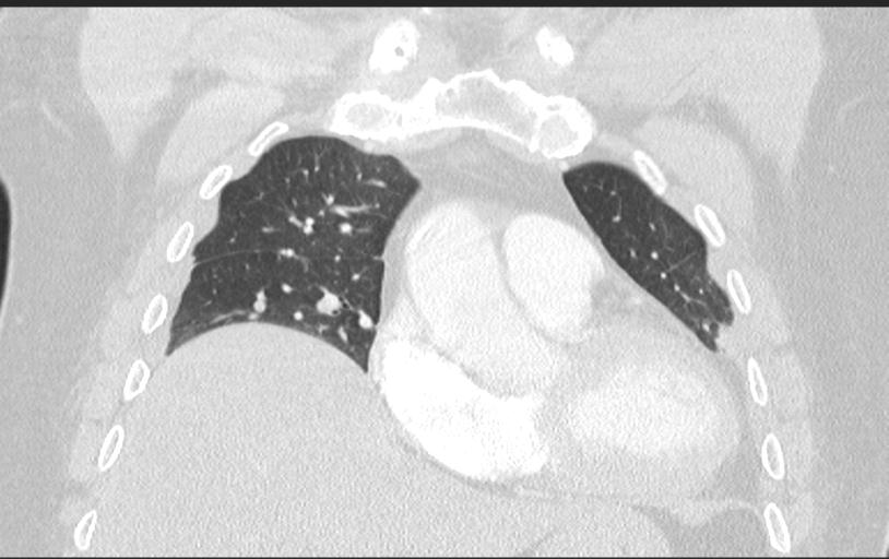 Aspirated tooth (Radiopaedia 28584-28844 Axial lung window 43).jpg