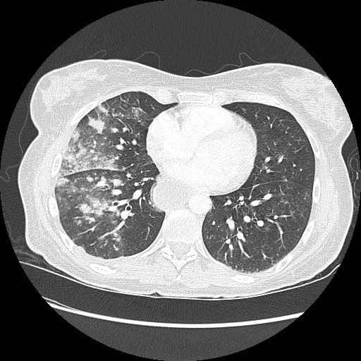 Aspiration pneumonia secondary to laparoscopic banding (Radiopaedia 18345-18183 lung window 69).jpg