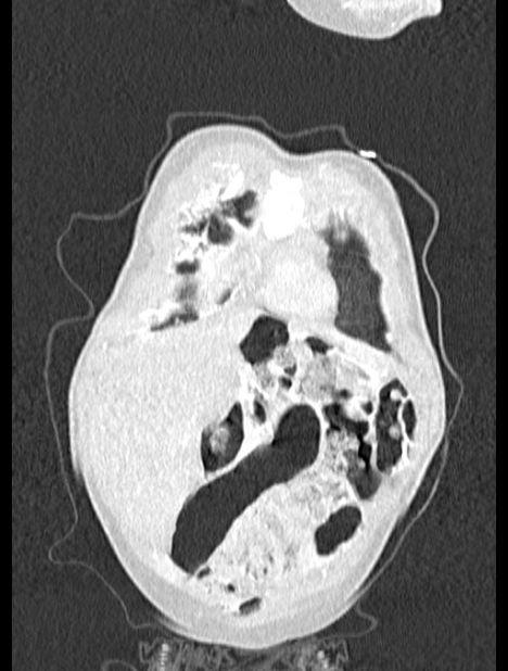 Asplenia syndrome (Radiopaedia 73083-83792 Coronal lung window 10).jpg