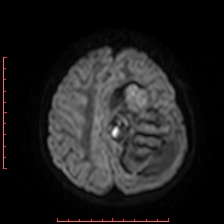 Astroblastoma (Radiopaedia 74287-85162 Axial DWI 79).jpg