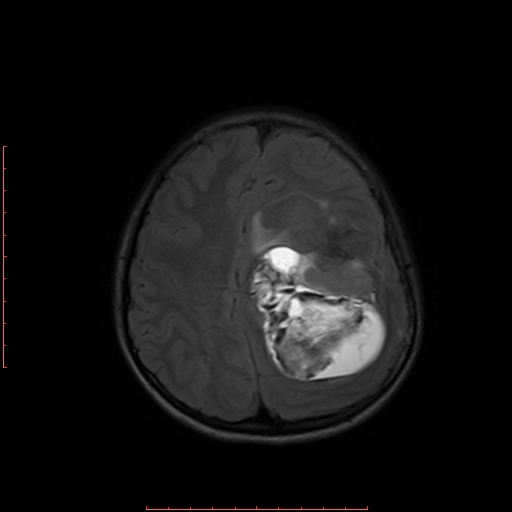 File:Astroblastoma (Radiopaedia 74287-85162 Axial FLAIR 16).jpg