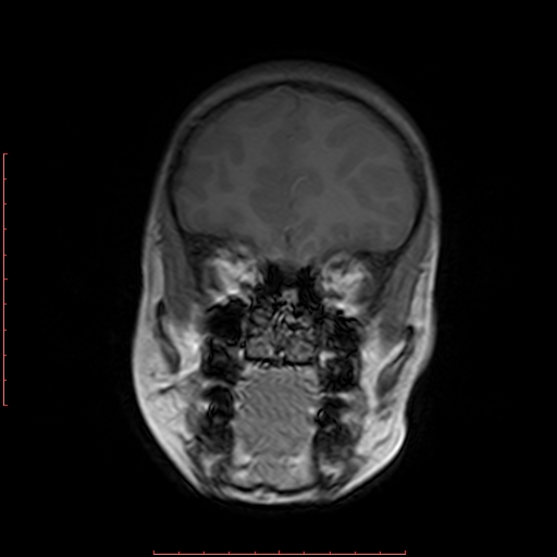 File:Astroblastoma (Radiopaedia 74287-85162 Coronal T1 4).jpg