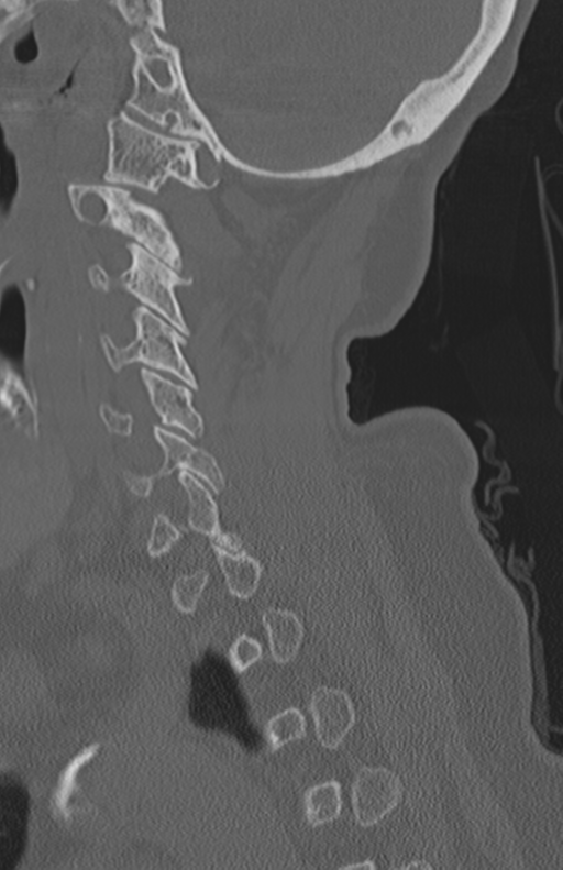 Atlanto-axial subluxation (Radiopaedia 36610-38176 Sagittal bone window 29).png