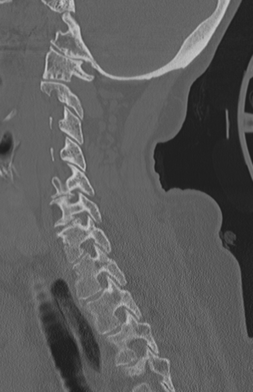 Atlanto-axial subluxation (Radiopaedia 36610-38176 Sagittal bone window 52).png