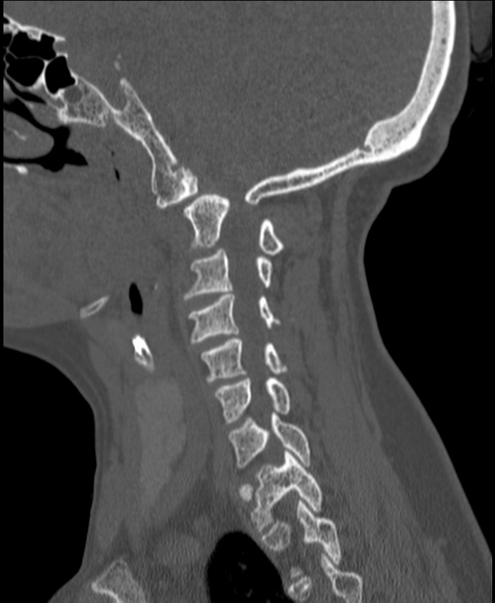 Atlanto-occipital assimilation with basilar invagination (Radiopaedia 70122-80188 Sagittal bone window 30).jpg