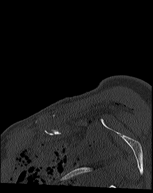 Atlanto-occipital dissociation - Traynelis type 1 (Radiopaedia 87570-103948 Sagittal bone window 1).jpg