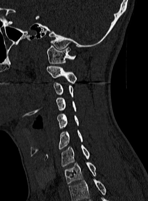 Atlantoaxial subluxation (Radiopaedia 44681-48450 Sagittal bone window 114).jpg