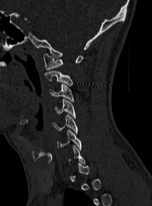 Atlantoaxial subluxation (Radiopaedia 44681-48450 Sagittal bone window 13).jpg