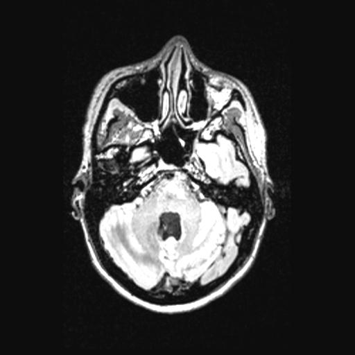 File:Atretic encephalocoele with inferior vermis hypoplasia (Radiopaedia 30443-31108 Axial 46).jpg
