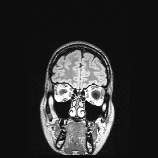 File:Atretic encephalocoele with inferior vermis hypoplasia (Radiopaedia 30443-31108 Coronal FLAIR 151).jpg