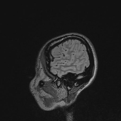 Atretic encephalocoele with inferior vermis hypoplasia (Radiopaedia 30443-31108 Sagittal FLAIR 134).jpg
