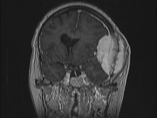 Atypical meningioma (Radiopaedia 62985-71406 Coronal T1 C+ 46).jpg