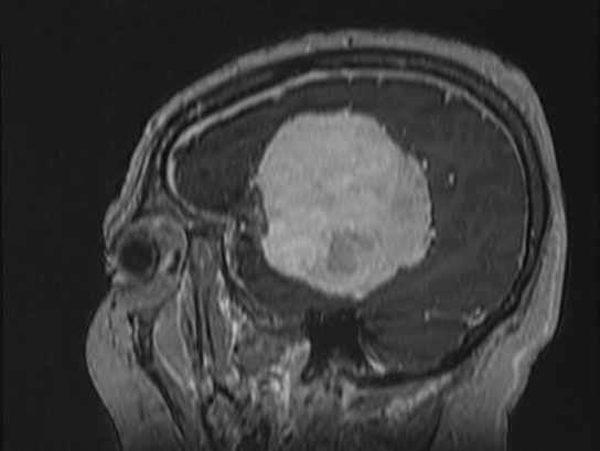 Atypical meningioma (Radiopaedia 62985-71406 Sagittal T1 C+ 78).jpg