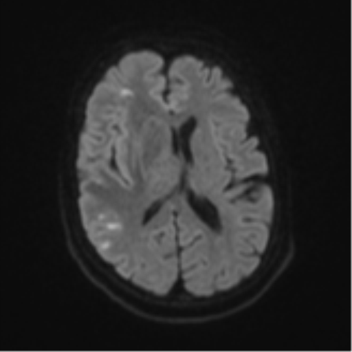 Atypical meningioma (WHO Grade II) (Radiopaedia 54742-60979 Axial DWI 44).png