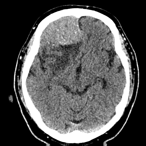 File:Atypical meningioma (WHO grade II) with brain invasion (Radiopaedia 57767-64728 Axial non-contrast 16).png