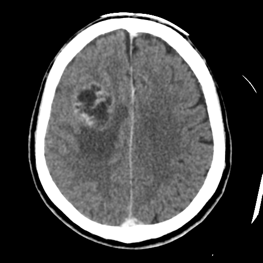 Atypical meningioma (WHO grade II) with osseous invasion (Radiopaedia 53654-59715 Axial C+ delayed 36).png