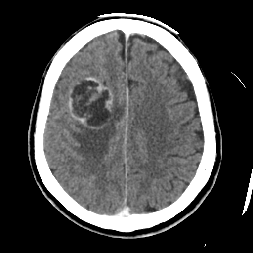 Atypical meningioma (WHO grade II) with osseous invasion (Radiopaedia 53654-59715 Axial C+ delayed 37).png