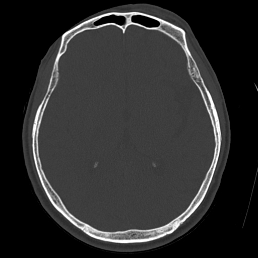 File:Atypical meningioma (WHO grade II) with osseous invasion (Radiopaedia 53654-59715 Axial bone window 42).png