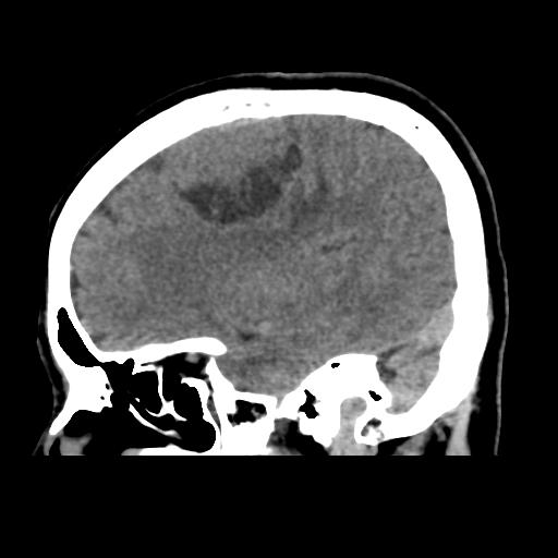 Atypical meningioma (WHO grade II) with osseous invasion (Radiopaedia 53654-59715 C 17).png