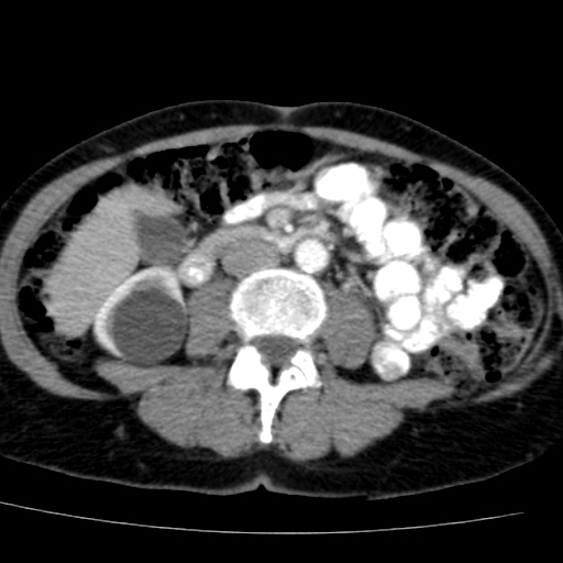 File:Atypical renal cyst (Radiopaedia 17536-17251 renal cortical phase 25).jpg