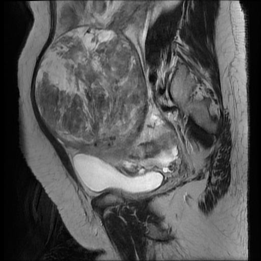 File:Atypical retroperitoneal lymphocoeles with large leiomyoma of uterus (Radiopaedia 32084-33027 Sagittal T2 22).jpg