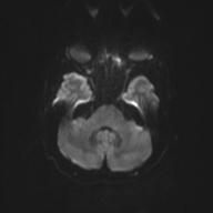 Autoimmune limbic encephalitis (Radiopaedia 30363-31005 Axial B0 and DWI 41).jpg
