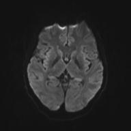 Autoimmune limbic encephalitis (Radiopaedia 30363-31005 Axial B0 and DWI 48).jpg