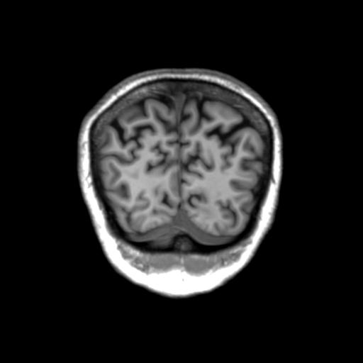 Autoimmune limbic encephalitis (Radiopaedia 30363-31005 Coronal T1 10).jpg