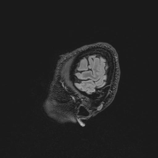 Autoimmune limbic encephalitis (Radiopaedia 30363-31005 Sagittal FLAIR 19).jpg