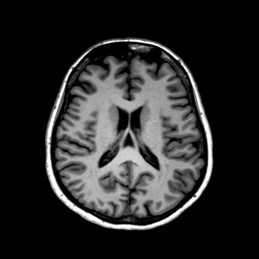 Autoimmune limbic encephalitis (Radiopaedia 30363-31005 T1 Axial 1mm 91).jpg