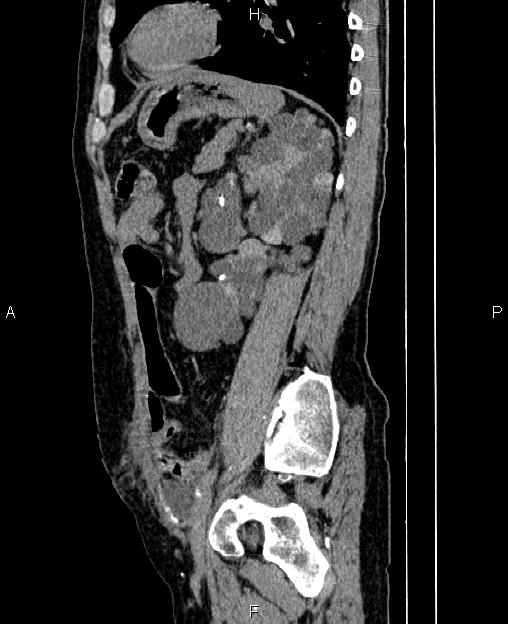 Autosomal dominant polycystic kidney disease (Radiopaedia 87830-104287 C 64).jpg