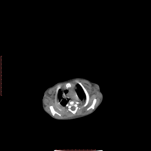 File:Autosomal recessive polycystic kidney disease associated with Caroli disease (Radiopaedia 61932-69984 Axial non-contrast 20).jpg