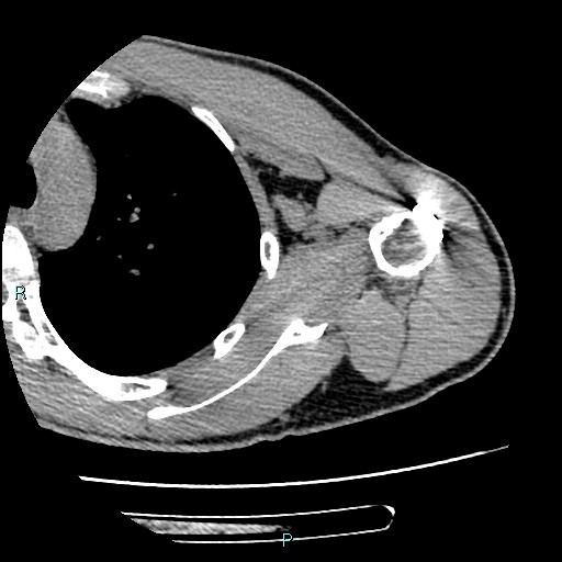 File:Avascular necrosis after fracture dislocations of the proximal humerus (Radiopaedia 88078-104655 D 63).jpg