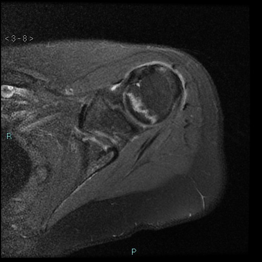 File:Avascular necrosis of the shoulder - Cruess stage I (Radiopaedia 77674-89886 Axial PD fat sat 8).jpg