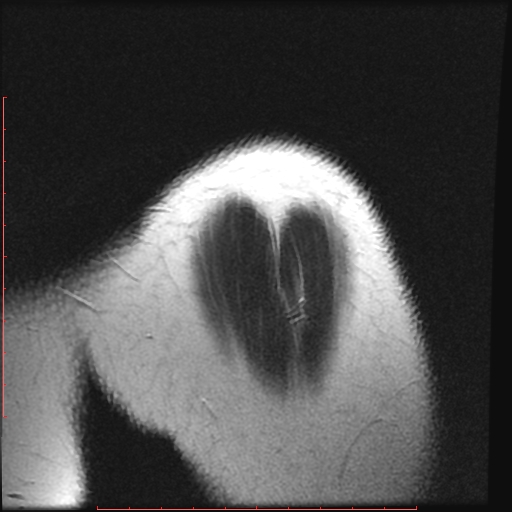 File:Avulsion fracture - greater tuberosity of humerus (Radiopaedia 25457-25703 Sagittal T2 12).jpg