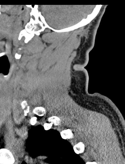 Axis peg fracture (type 3) and atlas lateral mass (type 4) fracture (Radiopaedia 37474-39324 D 19).png