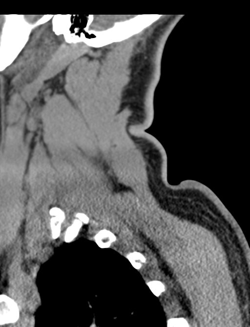 Axis peg fracture (type 3) and atlas lateral mass (type 4) fracture (Radiopaedia 37474-39324 D 66).png
