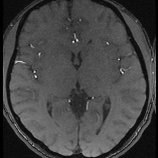 Azygos anterior cerebral artery (Radiopaedia 17059-16756 Axial MRA 15).jpg