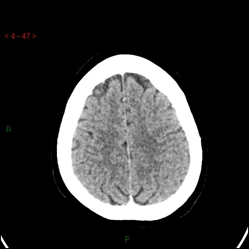 Azygos anterior cerebral artery (Radiopaedia 51987-57833 A 47).jpg