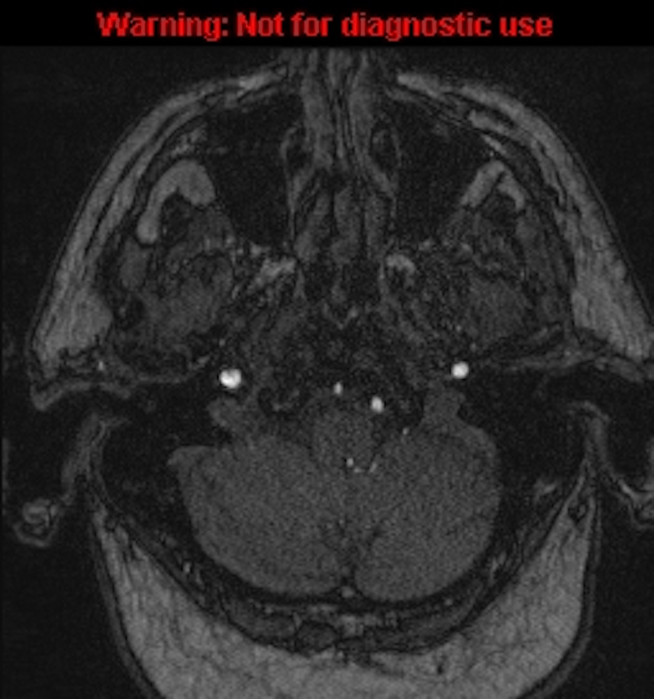 Azygos anterior cerebral artery (Radiopaedia 59325-66677 Axial MRA 17).jpg