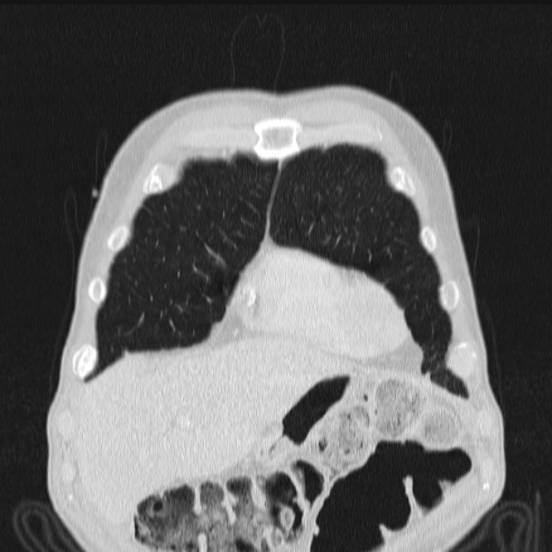 Azygos lobe (Radiopaedia 38259-40275 Coronal lung window 15).jpg