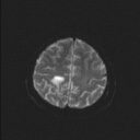 File:Balo concentric sclerosis (Radiopaedia 50458-55940 Axial DWI 28).jpg