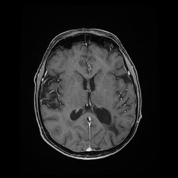 Balo concentric sclerosis (Radiopaedia 53875-59982 Axial LAVA C+ 144).jpg