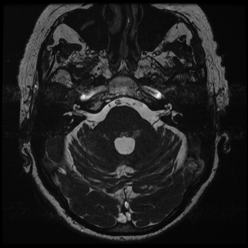 File:Balo concentric sclerosis (Radiopaedia 53875-59982 Axial T2 FIESTA 38).jpg