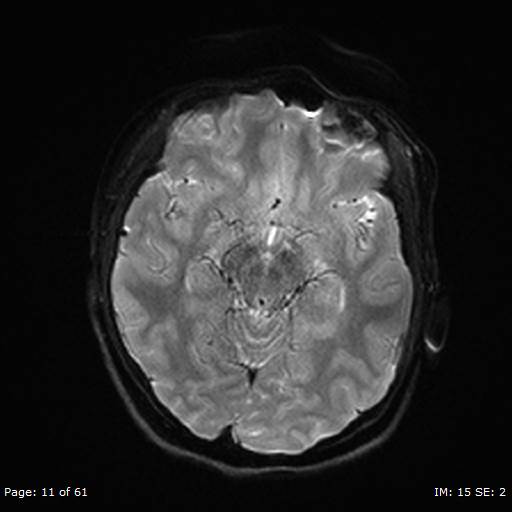 Balo concentric sclerosis (Radiopaedia 61637-69636 Axial DWI 11).jpg