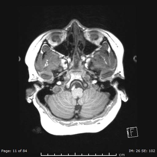 Balo concentric sclerosis (Radiopaedia 61637-69636 Axial T1 11).jpg